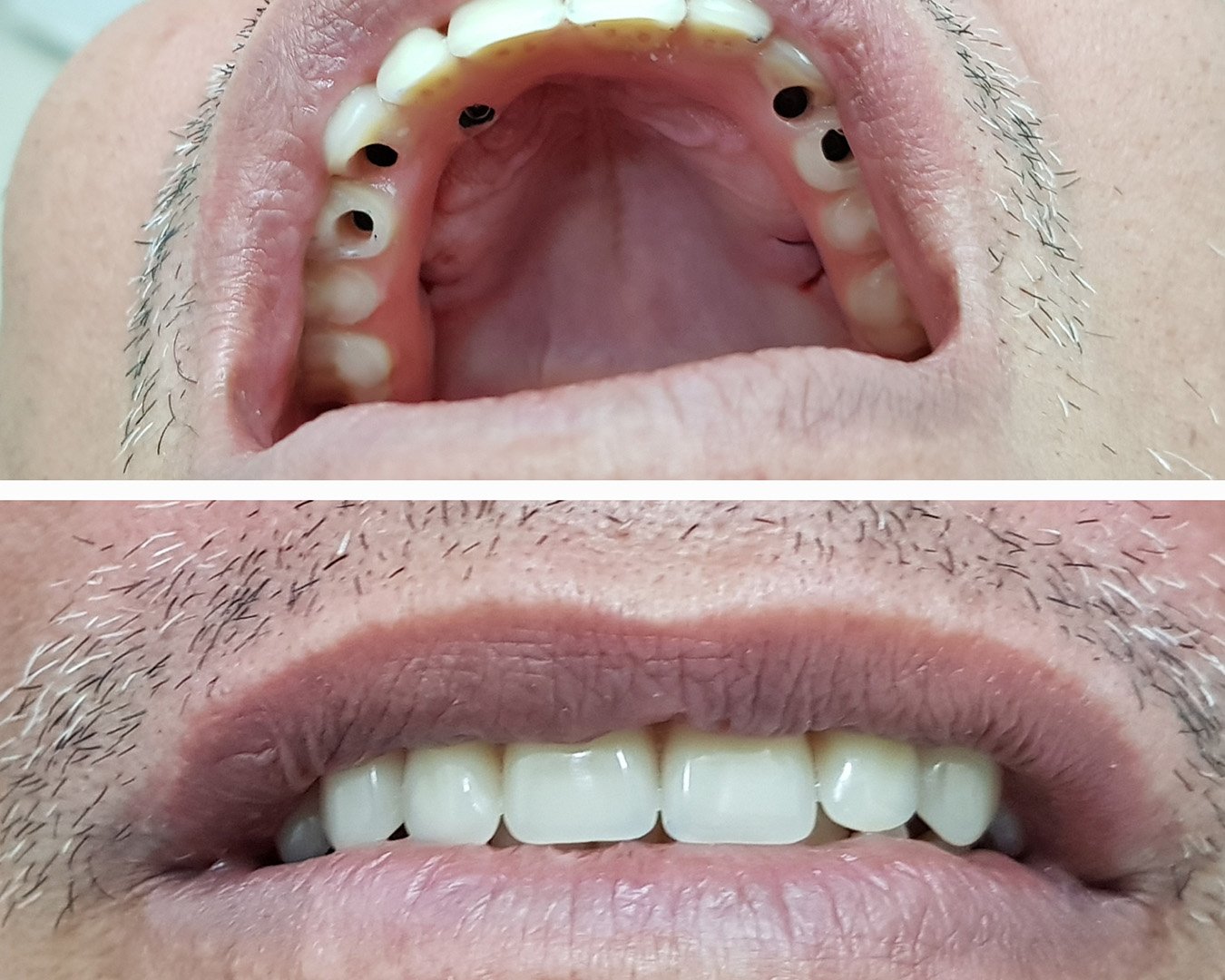 Cirugia para colocação de prótese protocolo