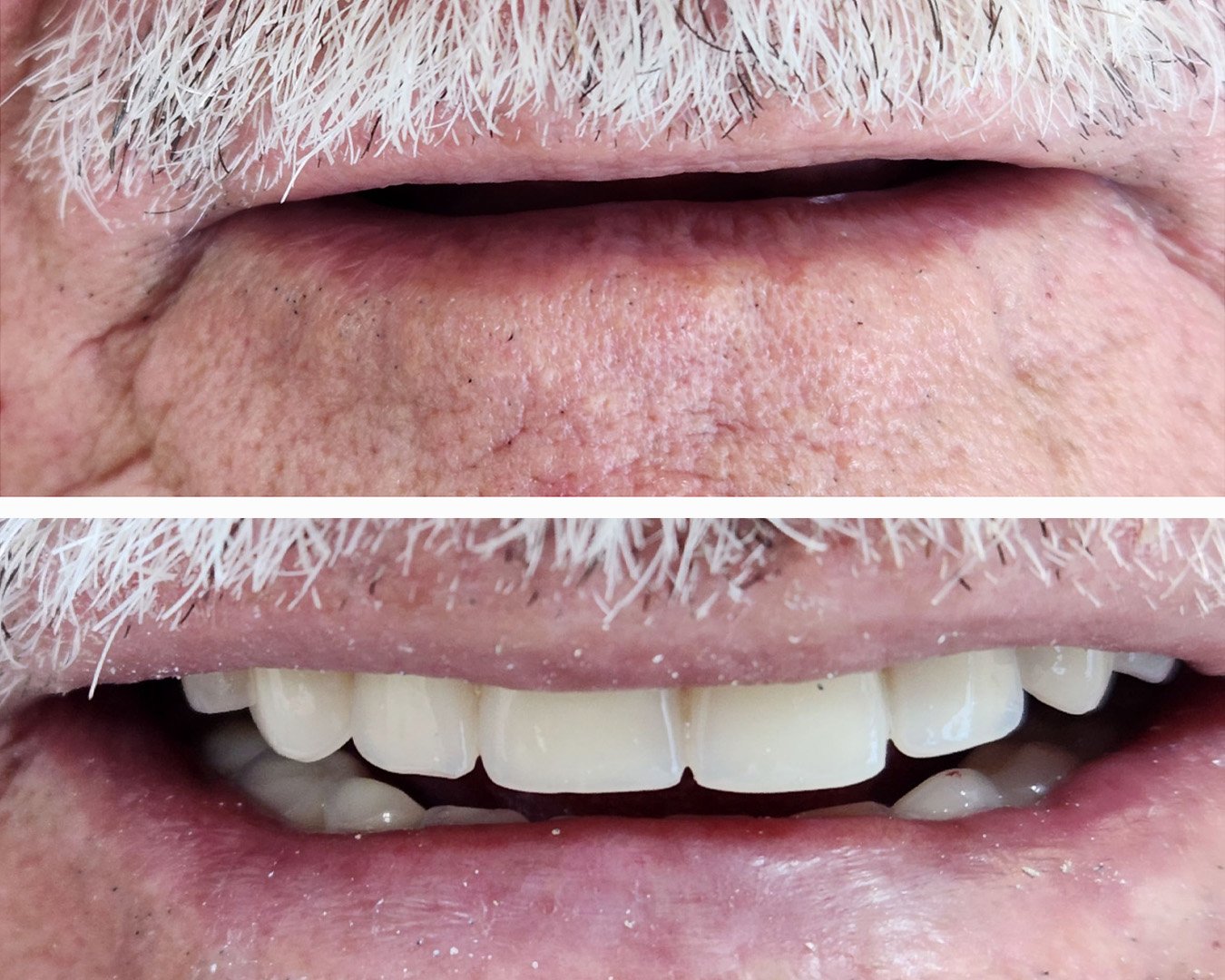 Cirugia para colocação de prótese protocolo
