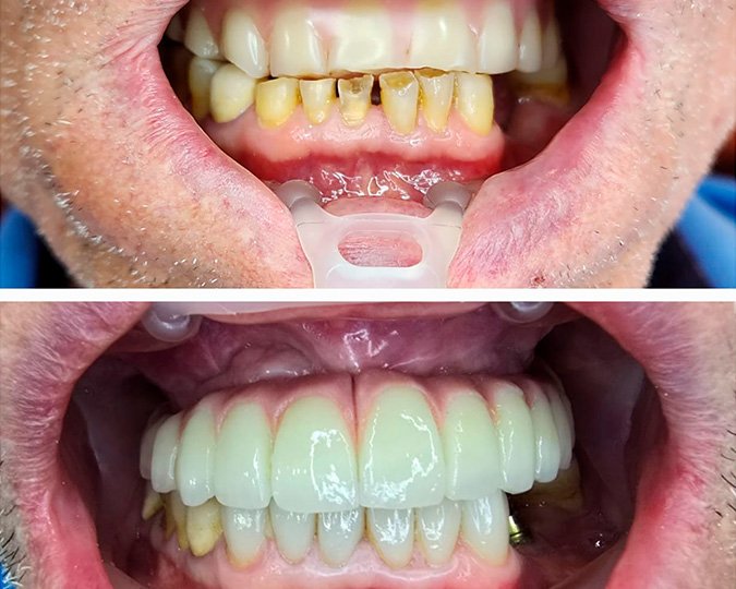 Cirugia para colocação de prótese protocolo