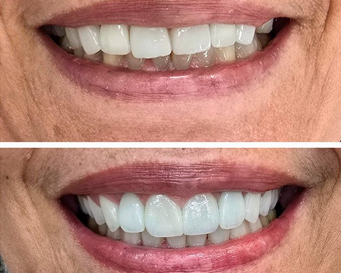 Cirugia para colocação de prótese unitaria
