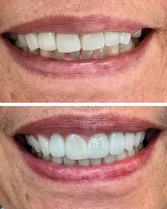 Cirugia para colocação de prótese unitaria