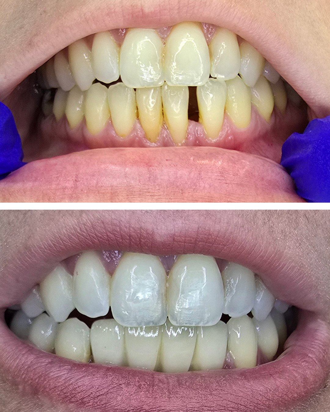 Cirugia para colocação de prótese unitaria