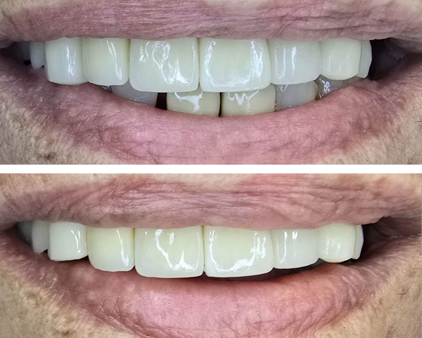 Cirugia para colocação de prótese unitaria