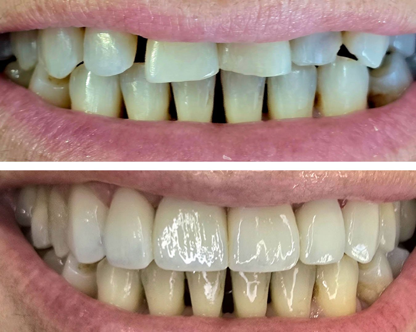 Cirugia para colocação de prótese unitaria