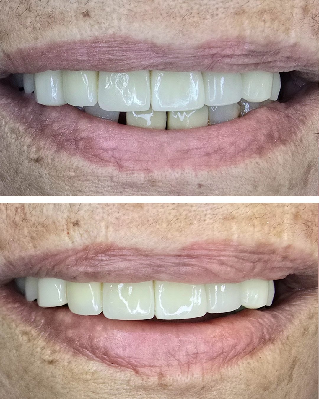 Cirugia para colocação de prótese unitaria