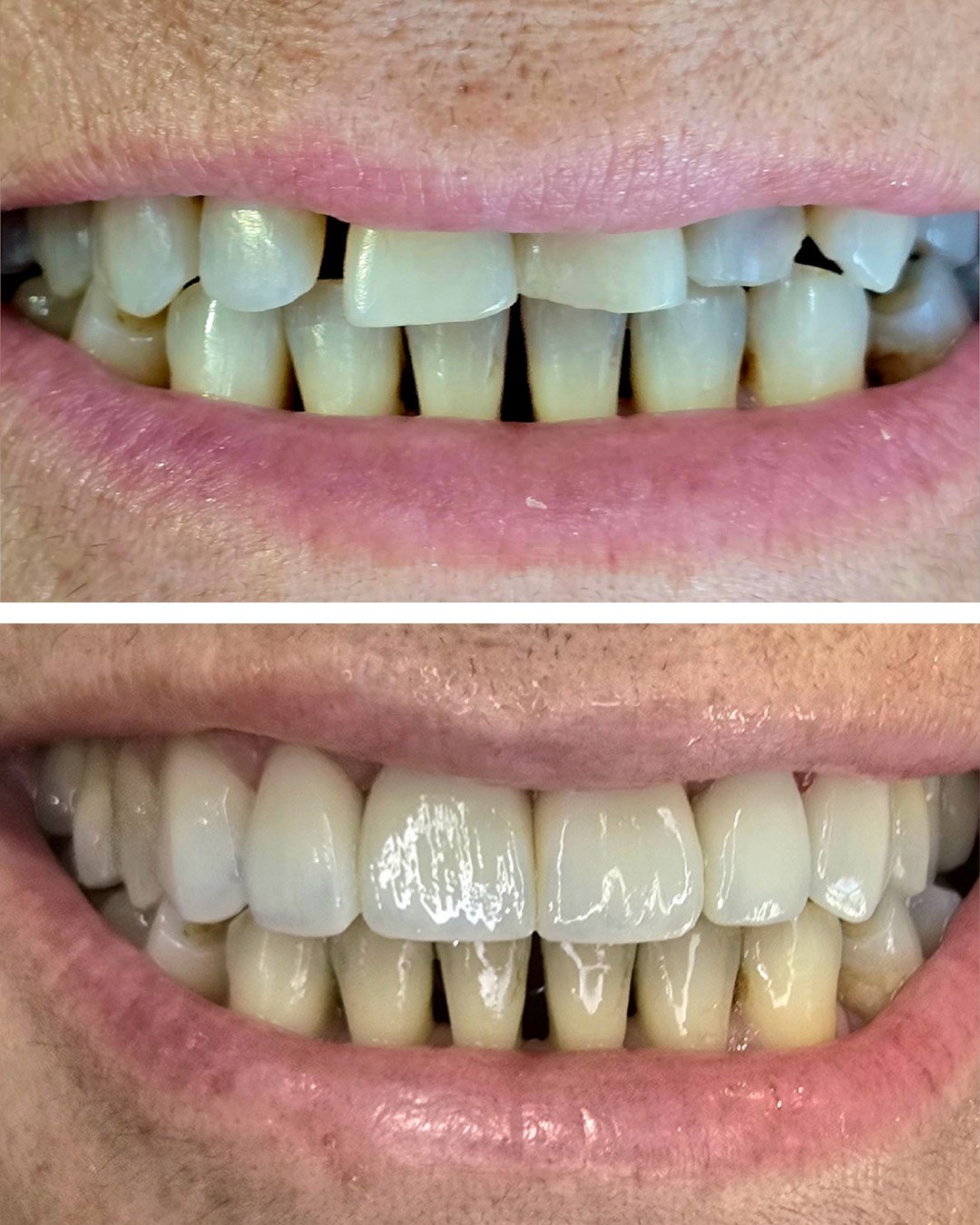 Cirugia para colocação de prótese unitaria